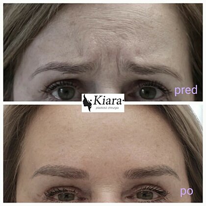 Botox application