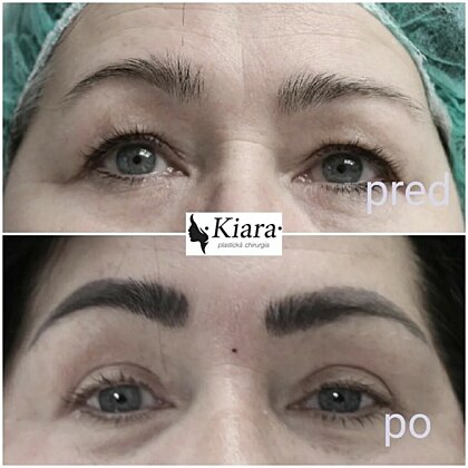Upper lids