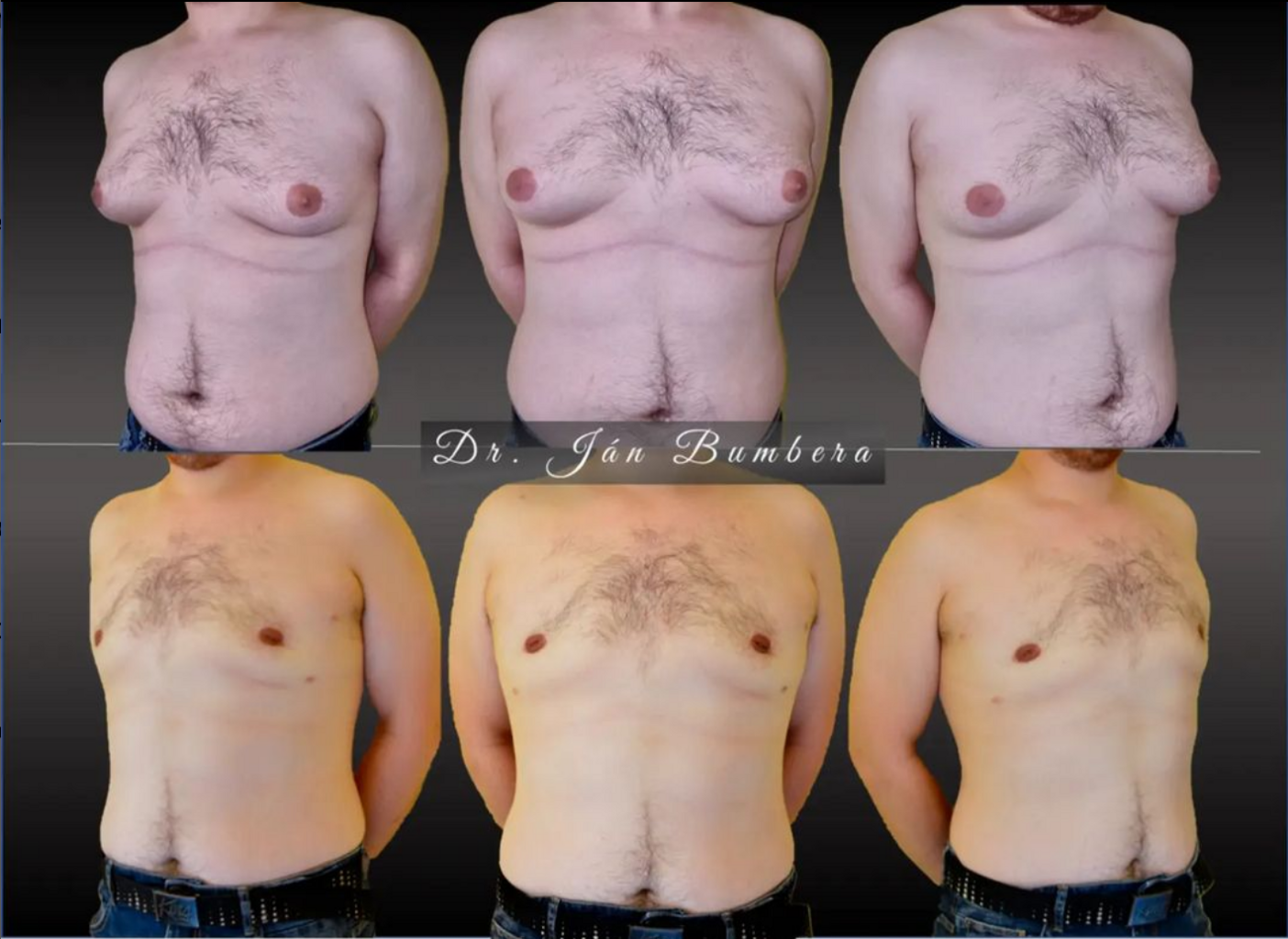 Gynecomastia surgery