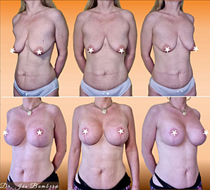 Breast lift and augmentation with implants