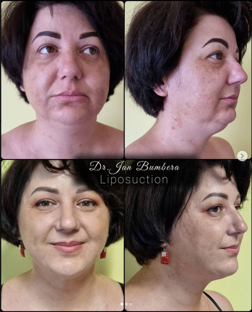 Chin correction using liposuction