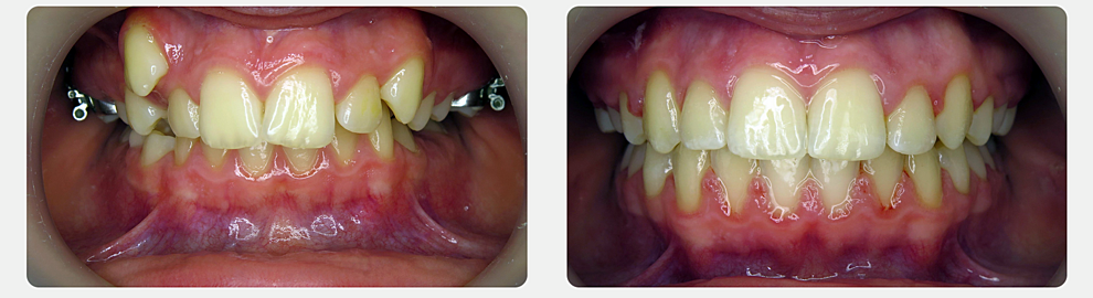 Canine tooth placement