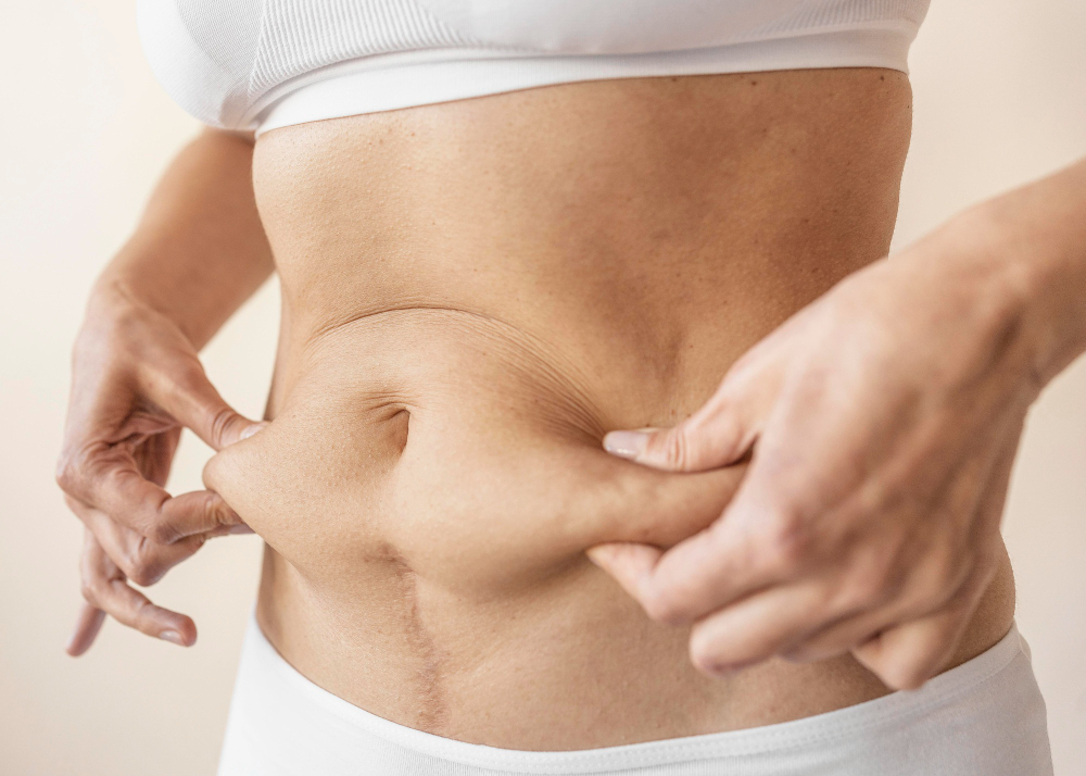 Tummy-Tuck (Abdominoplasty)